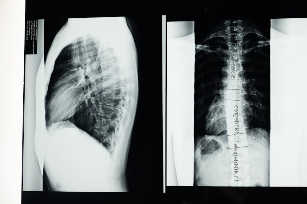 Radiografias em chapas pretas e brancas. Ilustração do texto sobre escoliose.